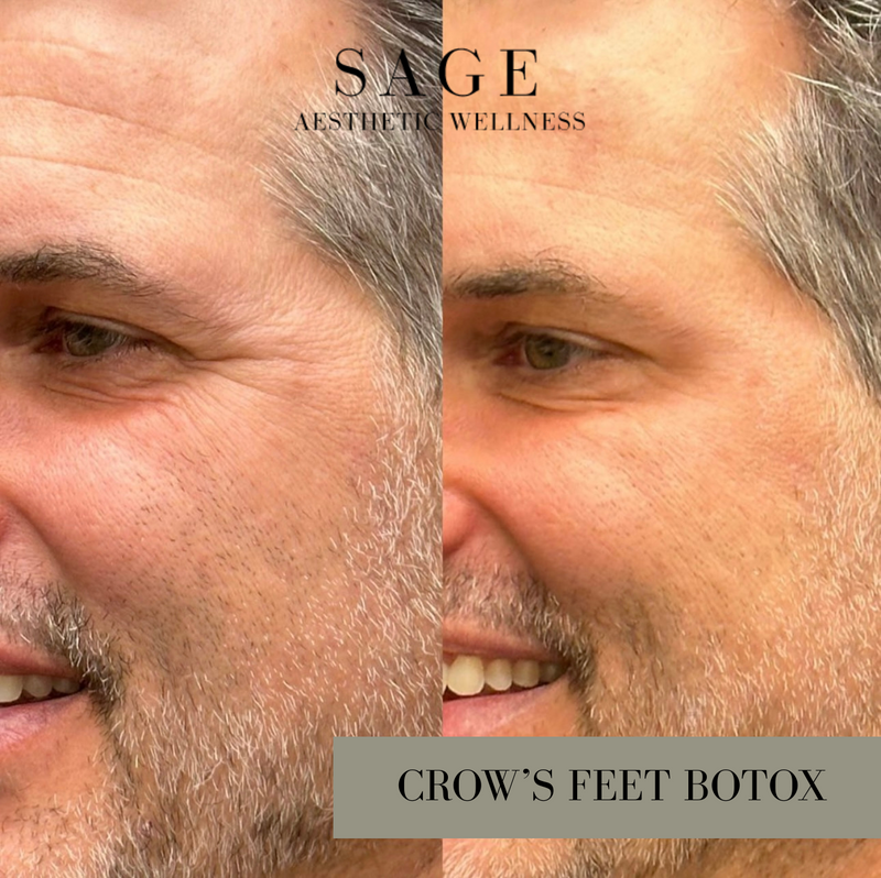 Crow’s feet Botox before and after results at Sage Aesthetic Wellness Scottsdale.