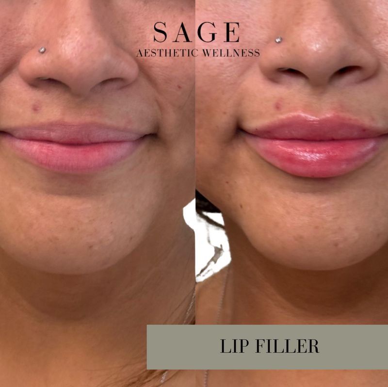 Lip filler before and after showing enhanced volume at Sage Aesthetic Wellness Scottsdale.