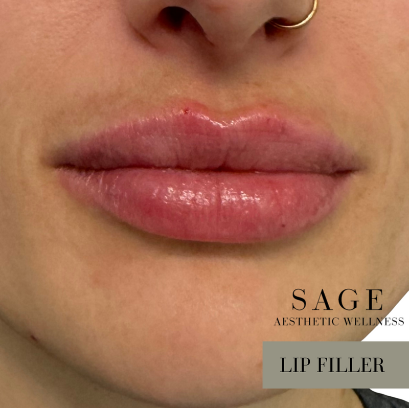 Close-up of lip filler results performed at Sage Aesthetic Wellness in Scottsdale.