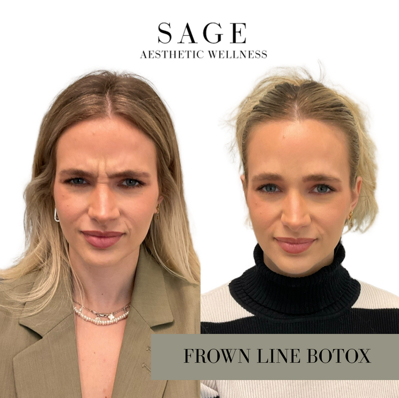 Before and after Botox injections for frown lines at Sage Aesthetic Wellness Scottsdale.